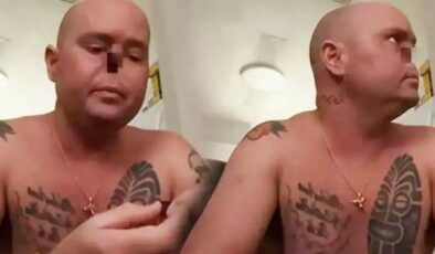 Grip sonrası burnunu tamamen kaybetti